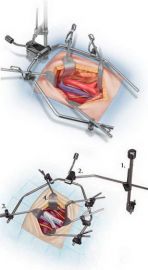 OMNI-TRACT 4020 Surgical FastSystems Standard Wishbone Frame